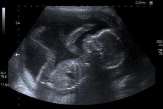 Unborn_baby_at_20_weeks_Credit_Steve_via_Flickr_CC_BY_NC_20_CNA.jpeg