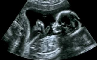 ultrasound-e1709050993504-810x500.jpg