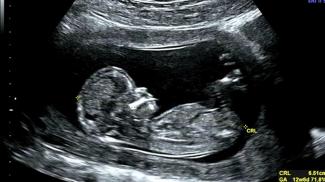 ultrasound3d56.jpg